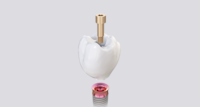 Screw-Retained-Implant-Crown-or-Bridge